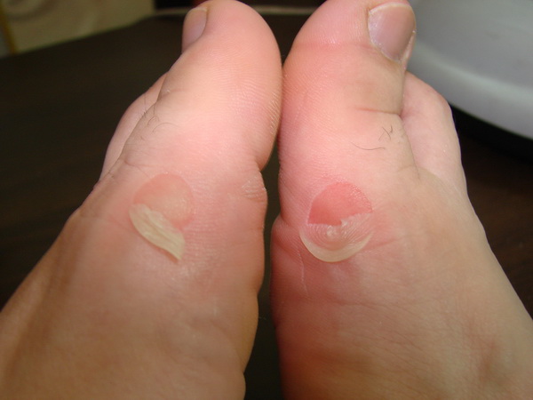 ��Ƥ�����͵Ľţ���̸���ô������һ������ʹ��